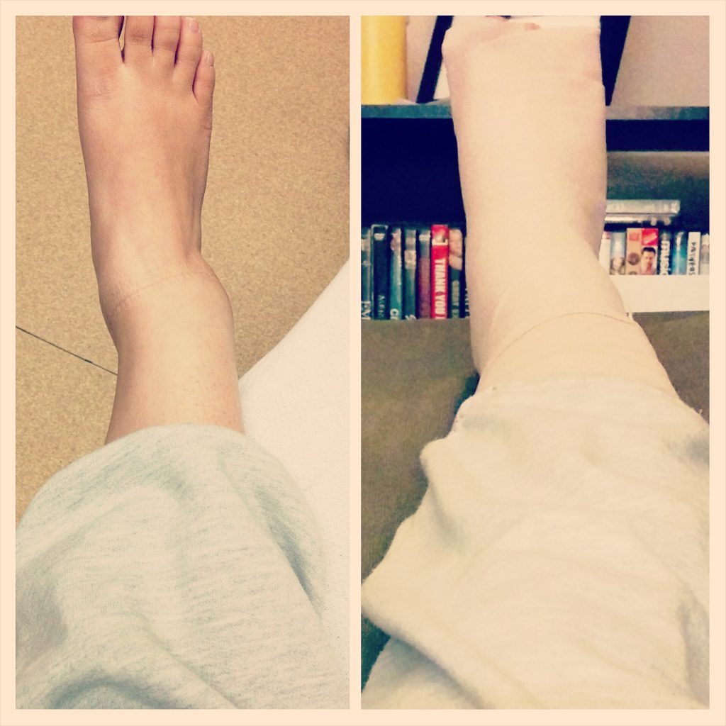 bimalleolar fracture